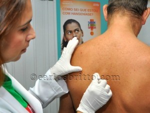 teste hanseníase